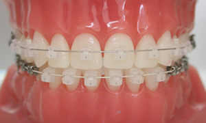 矯正歯科・大人の矯正
